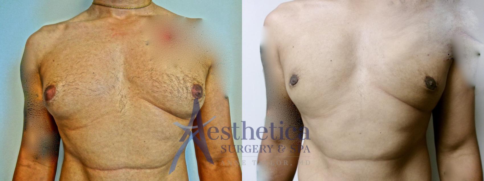 Gynecomastia Case 904 Before & After Front | Columbus, OH | Aesthetica Surgery & Spa