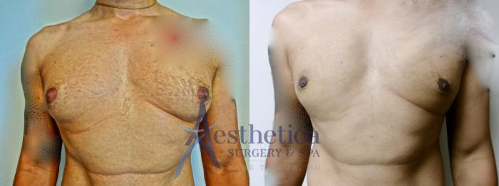 Gynecomastia Case 904 Before & After Front | Columbus, OH | Aesthetica Surgery & Spa