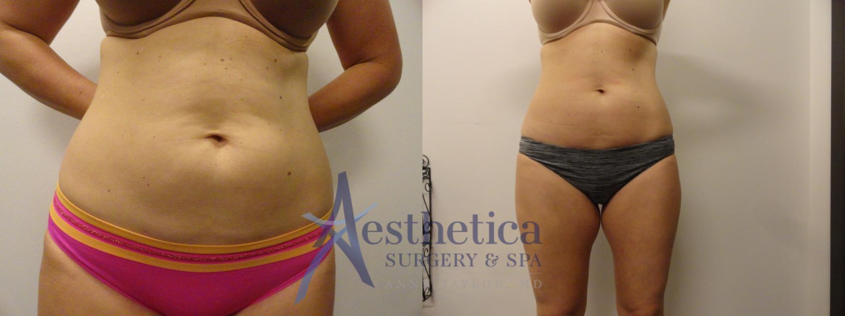 Liposuction Case 288 Before & After View #1 | Columbus, OH | Aesthetica Surgery & Spa