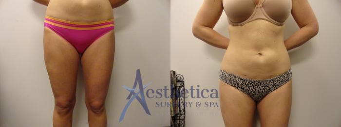 Liposuction Case 288 Before & After View #2 | Columbus, OH | Aesthetica Surgery & Spa