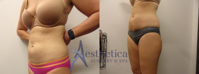 Liposuction Case 288 Before & After View #3 | Columbus, OH | Aesthetica Surgery & Spa