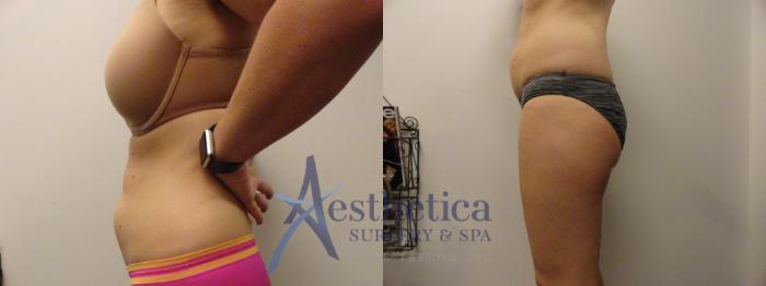 Liposuction Case 288 Before & After View #4 | Columbus, OH | Aesthetica Surgery & Spa