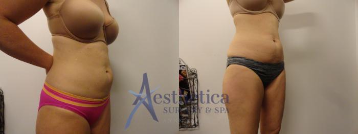 Liposuction Case 288 Before & After View #5 | Columbus, OH | Aesthetica Surgery & Spa