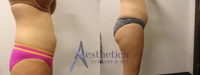 Liposuction Case 288 Before & After View #7 | Columbus, OH | Aesthetica Surgery & Spa