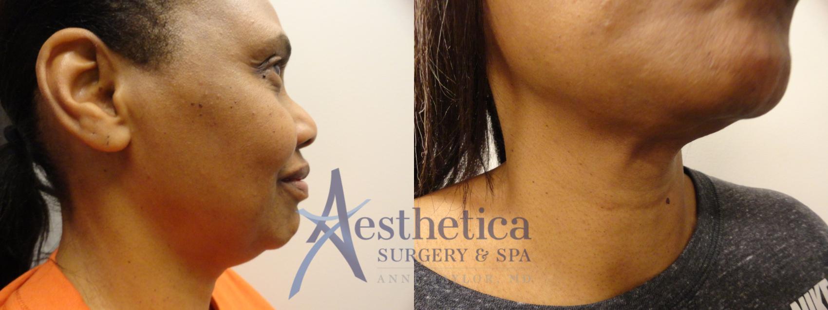 Liposuction Case 299 Before & After View #2 | Columbus, OH | Aesthetica Surgery & Spa