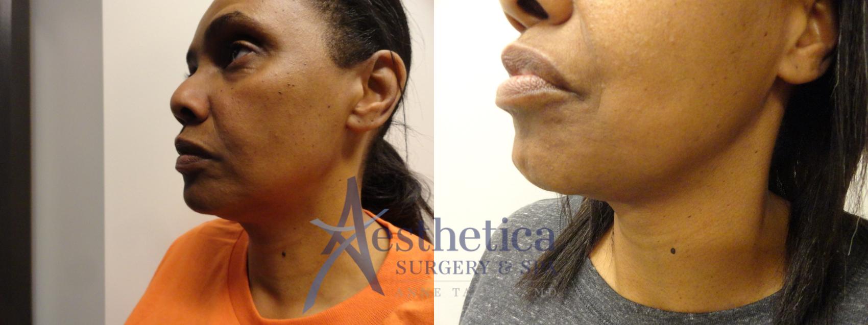 Liposuction Case 299 Before & After View #3 | Columbus, OH | Aesthetica Surgery & Spa