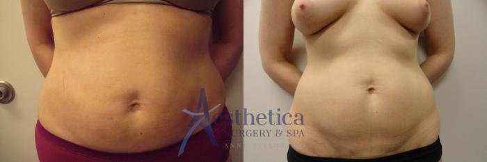 Liposuction Case 302 Before & After View #1 | Columbus, OH | Aesthetica Surgery & Spa