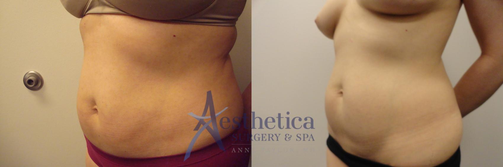 Liposuction Case 302 Before & After View #2 | Columbus, OH | Aesthetica Surgery & Spa