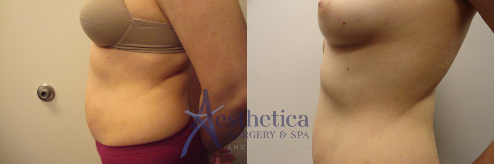 Liposuction Case 302 Before & After View #3 | Columbus, OH | Aesthetica Surgery & Spa