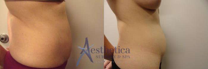 Liposuction Case 302 Before & After View #4 | Columbus, OH | Aesthetica Surgery & Spa