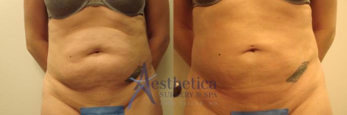 Liposuction Case 437 Before & After Front | Columbus, OH | Aesthetica Surgery & Spa
