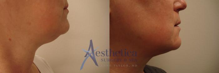 Liposuction Case 472 Before & After Right Side | Columbus, OH | Aesthetica Surgery & Spa