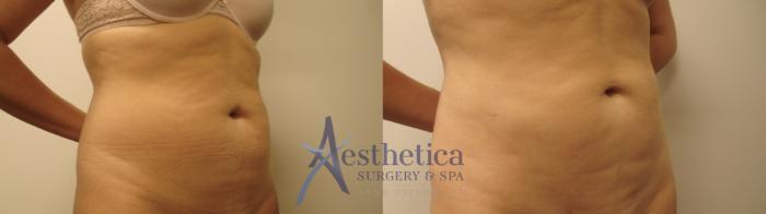 Liposuction Case 488 Before & After Right Oblique | Columbus, OH | Aesthetica Surgery & Spa