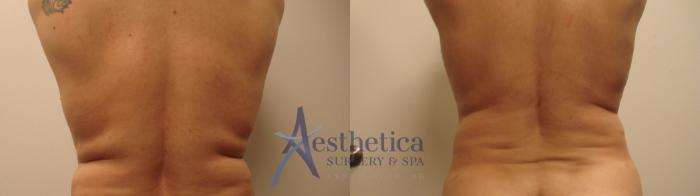 Liposuction Case 489 Before & After Back | Columbus, OH | Aesthetica Surgery & Spa