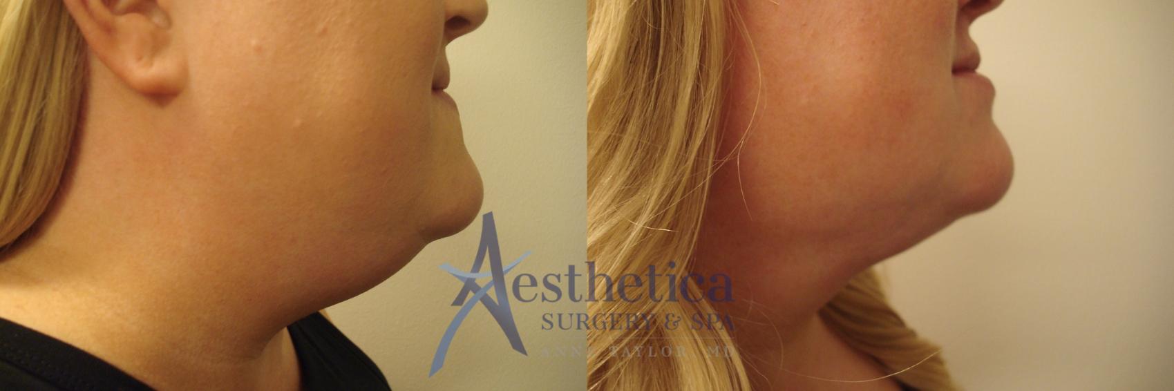 Liposuction Case 502 Before & After Right Side | Worthington, OH | Aesthetica Surgery & Spa
