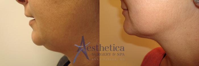 Liposuction Case 518 Before & After Left Side | Columbus, OH | Aesthetica Surgery & Spa
