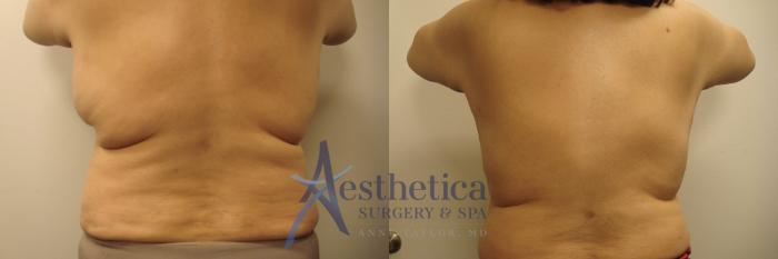 Liposuction Case 604 Before & After Back | Columbus, OH | Aesthetica Surgery & Spa