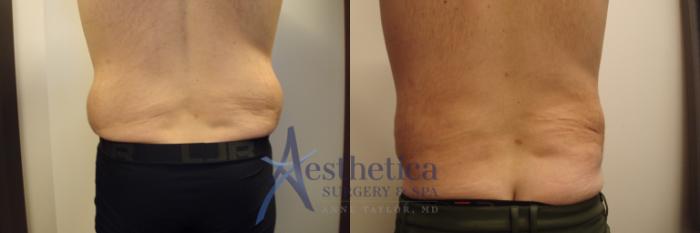Liposuction Case 678 Before & After Back | Columbus, OH | Aesthetica Surgery & Spa