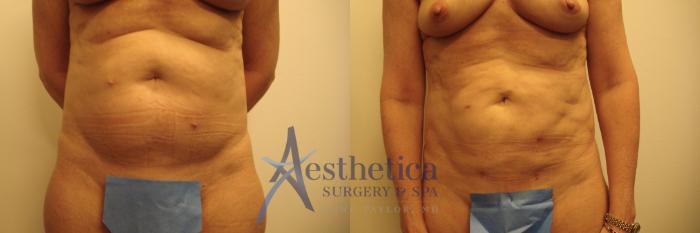 Liposuction Case 690 Before & After Front | Columbus, OH | Aesthetica Surgery & Spa