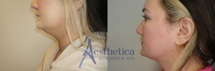Liposuction Case 784 Before & After Left Side | Columbus, OH | Aesthetica Surgery & Spa