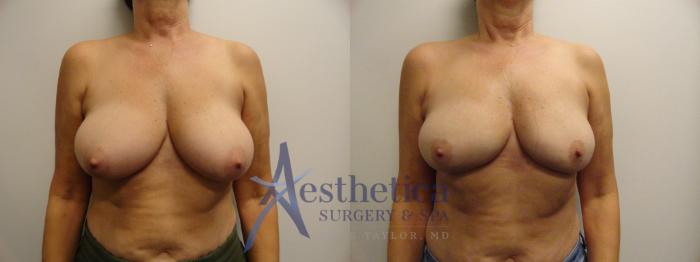 Liposuction Case 838 Before & After Front | Columbus, OH | Aesthetica Surgery & Spa