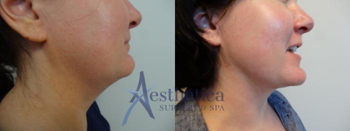 Liposuction Case 895 Before & After Right Side | Columbus, OH | Aesthetica Surgery & Spa