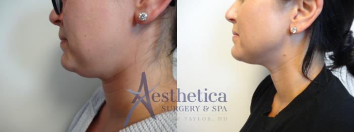 Liposuction Case 899 Before & After Left Side | Columbus, OH | Aesthetica Surgery & Spa