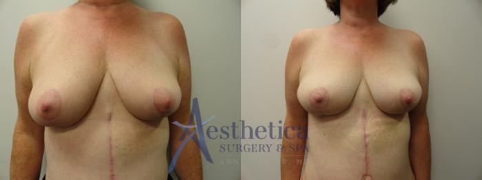 Mommy Makeover Case 219 Before & After View #1 | Columbus, OH | Aesthetica Surgery & Spa