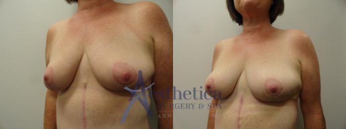 Mommy Makeover Case 219 Before & After View #2 | Columbus, OH | Aesthetica Surgery & Spa