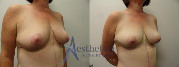 Mommy Makeover Case 219 Before & After View #3 | Columbus, OH | Aesthetica Surgery & Spa