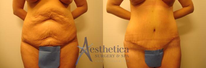 Mommy Makeover Case 476 Before & After front  | Columbus, OH | Aesthetica Surgery & Spa