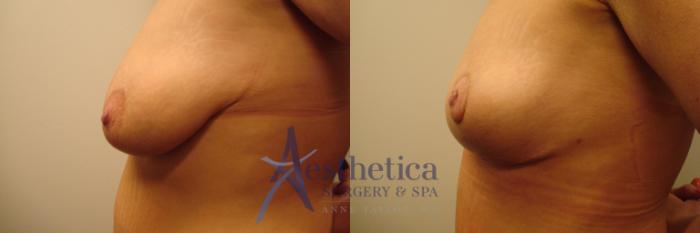 Mommy Makeover Case 476 Before & After Left Oblique | Columbus, OH | Aesthetica Surgery & Spa