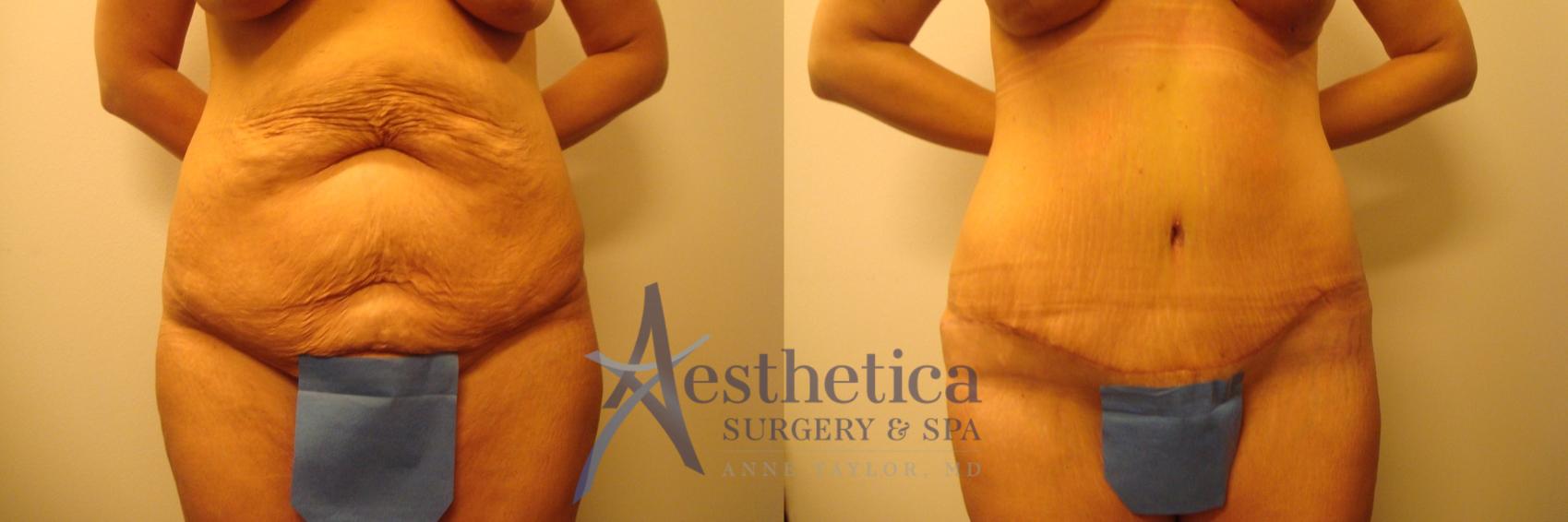 4 Types of Tummy Tuck Procedures Offered By Ohio Plastic Surgery  Specialists - Ohio Plastic Surgery Specialists