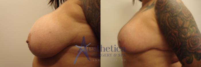 Mommy Makeover Case 478 Before & After Left Oblique | Columbus, OH | Aesthetica Surgery & Spa