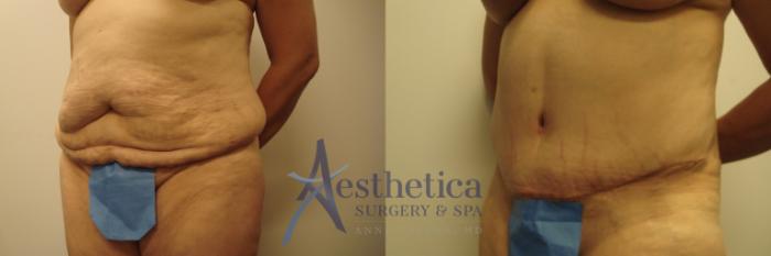 Mommy Makeover Case 479 Before & After Right Oblique | Columbus, OH | Aesthetica Surgery & Spa