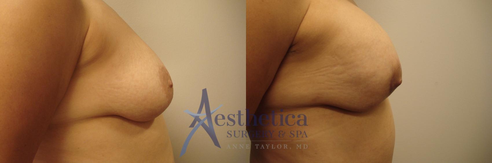 Mommy Makeover Case 479 Before & After Right Side | Columbus, OH | Aesthetica Surgery & Spa