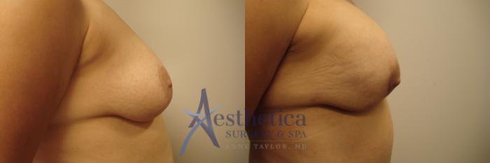 Mommy Makeover Case 479 Before & After Right Side | Columbus, OH | Aesthetica Surgery & Spa