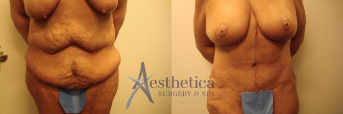Mommy Makeover Case 500 Before & After Front | Columbus, OH | Aesthetica Surgery & Spa