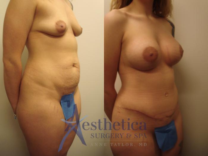 Mommy Makeover Case 515 Before & After Right Oblique | Columbus, OH | Aesthetica Surgery & Spa