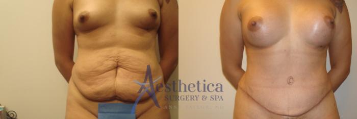 Mommy Makeover Case 537 Before & After Front | Columbus, OH | Aesthetica Surgery & Spa
