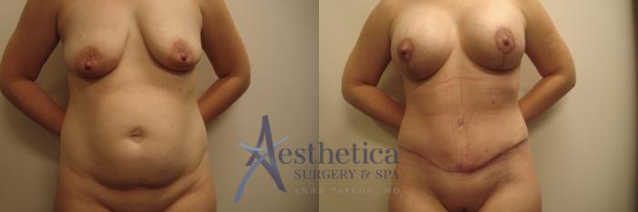Mommy Makeover Case 540 Before & After Front | Columbus, OH | Aesthetica Surgery & Spa