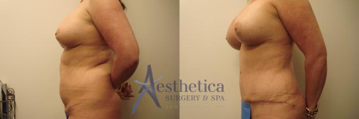 Mommy Makeover Case 619 Before & After Front | Columbus, OH | Aesthetica Surgery & Spa