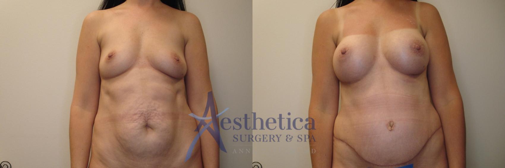 Mommy Makeover Case 795 Before & After Front | Columbus, OH | Aesthetica Surgery & Spa