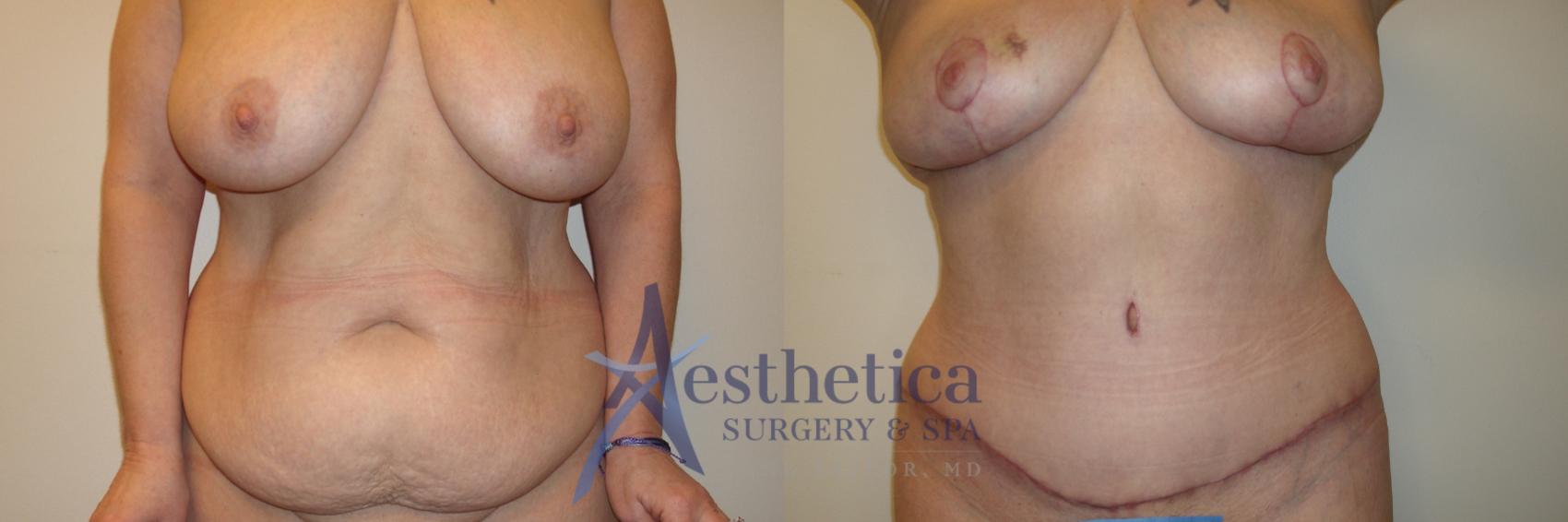 Mommy Makeover Case 799 Before & After Front | Columbus, OH | Aesthetica Surgery & Spa