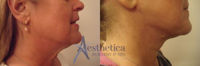 Neck Surgery Case 514 Before & After Right Side | Columbus, OH | Aesthetica Surgery & Spa