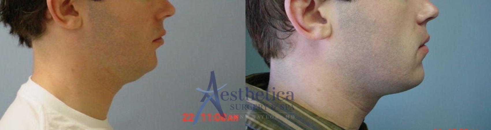Neck Surgery Case 55 Before & After View #1 | Columbus, OH | Aesthetica Surgery & Spa
