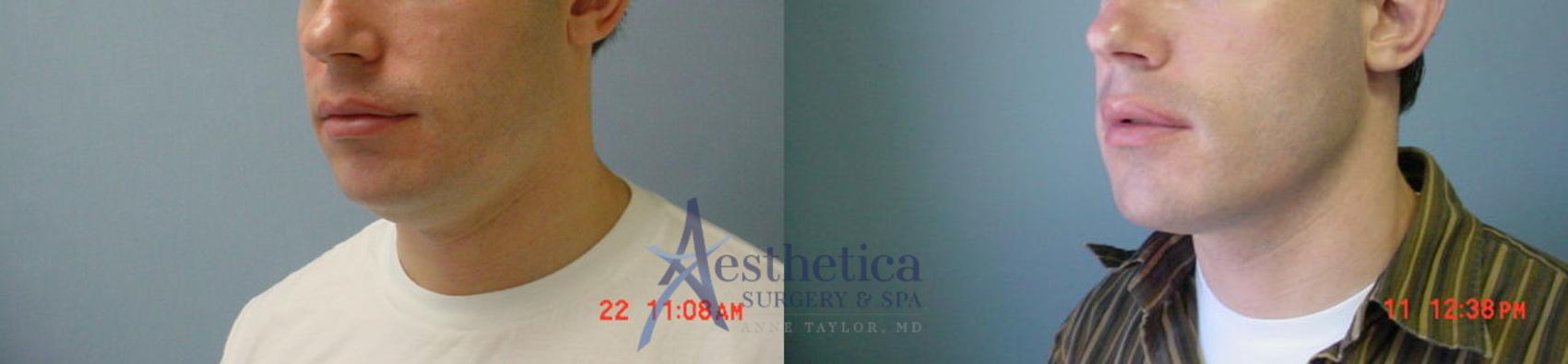 Neck Surgery Case 55 Before & After View #2 | Worthington, OH | Aesthetica Surgery & Spa