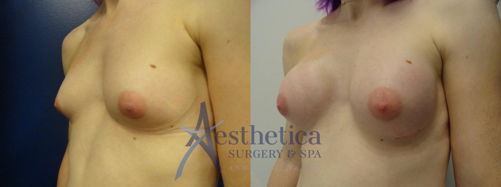 Transgender Top Surgery (FTM/MTF) Case 201 Before & After View #2 | Worthington, OH | Aesthetica Surgery & Spa