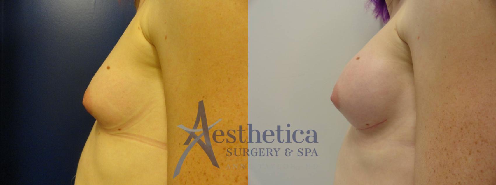 Transgender Top Surgery (FTM/MTF) Case 201 Before & After View #3 | Worthington, OH | Aesthetica Surgery & Spa