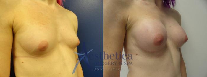 Transgender Top Surgery (FTM/MTF) Case 201 Before & After View #4 | Columbus, OH | Aesthetica Surgery & Spa